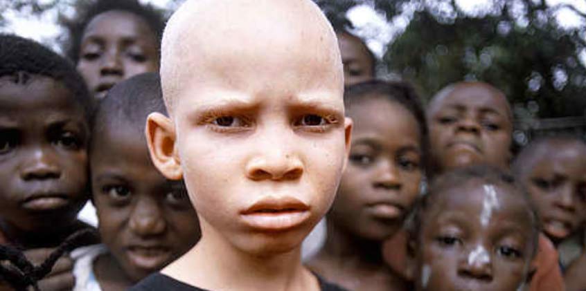 Living With Albinism in Africa
